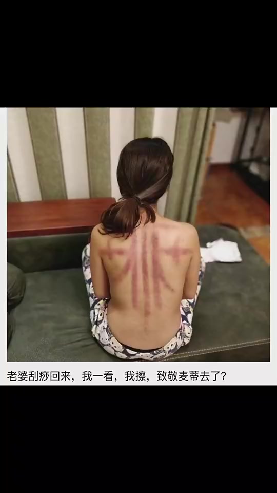 你别说，还真像！老婆这刮痧是去致敬麦迪吗？🙊